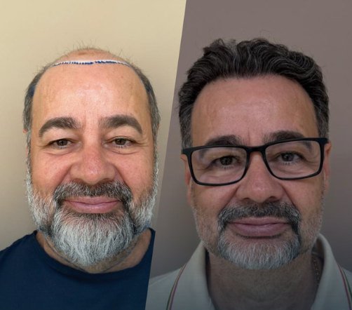 Antes e depois do transplante capilar de Adailton, vista frontal