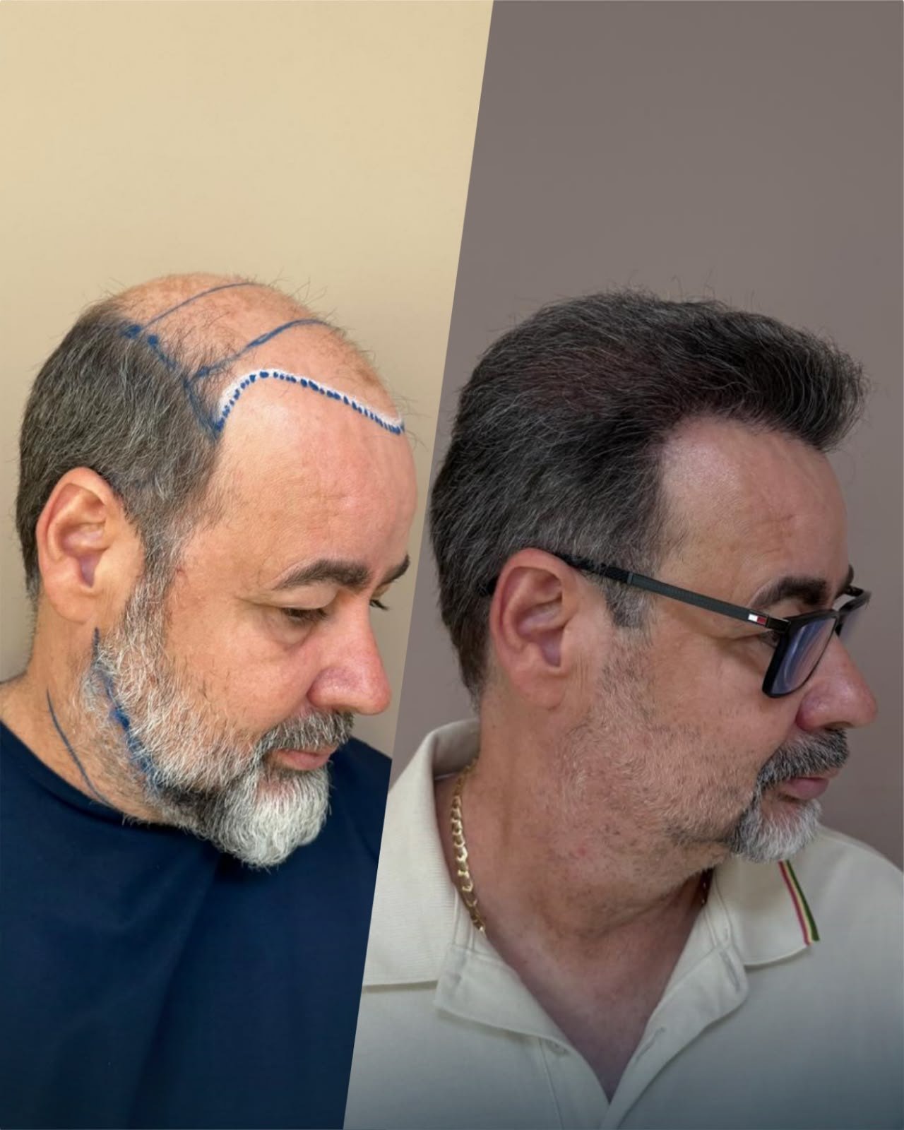 Antes e depois do transplante capilar de Adailton, vista lateral