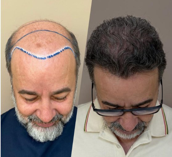 Antes e depois do transplante capilar de Adailton, vista superior