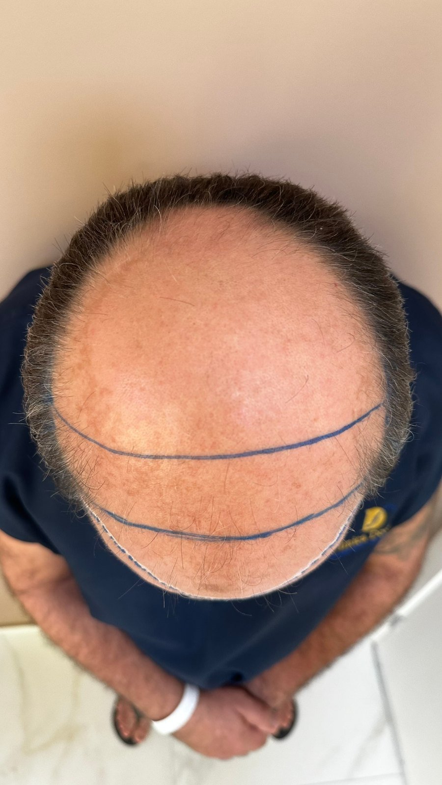 Coroa de Adailton antes do transplante capilar, com perda capilar total