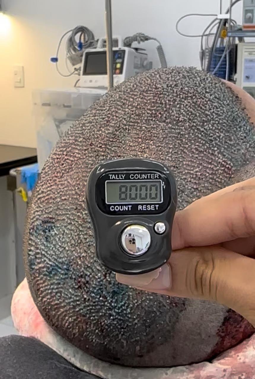 Contador de folículos implantados no transplante capilar de Glauber: 8.000 folículos