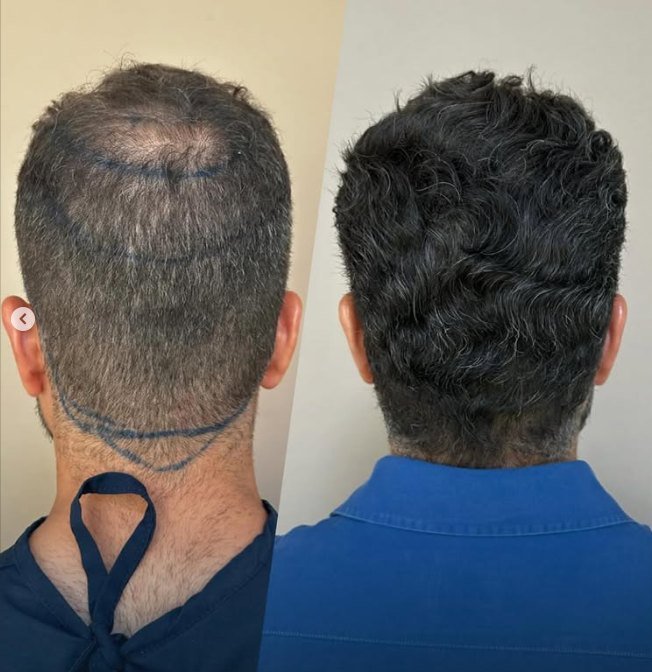 Antes e depois da coroa de Glauber, 7 meses após o transplante capilar
