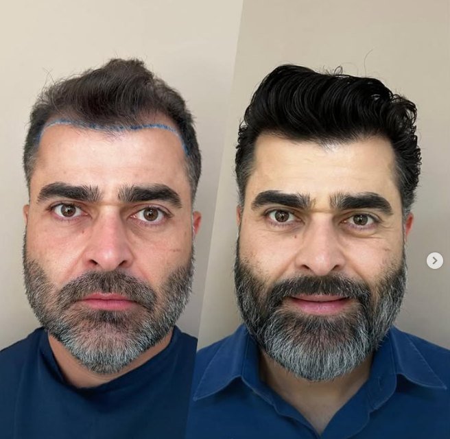 Antes e depois do transplante capilar de Glauber, vista frontal, 7 meses após