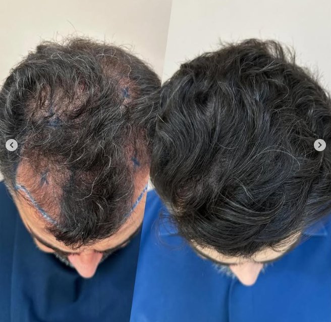Antes e depois do transplante capilar de Glauber, vista superior, 7 meses após