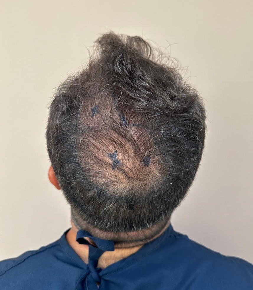 Área da coroa de Glauber antes do transplante capilar