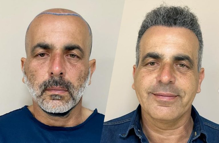 Antes e depois do transplante capilar de Jean, vista frontal