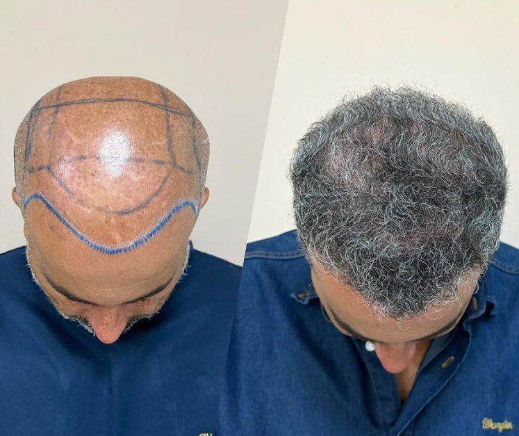Antes e depois do transplante capilar de Jean, vista superior