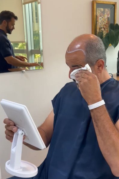Jean emocionado na avaliação inicial do transplante capilar