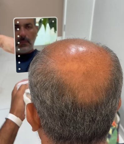 Calvície grau 7 de Jean antes do transplante capilar
