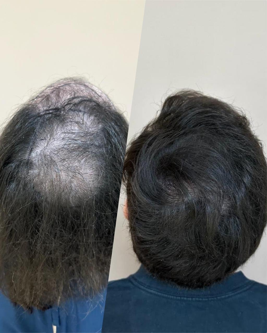 Antes e depois da coroa e reconstrução do redemoinho de João Pedro