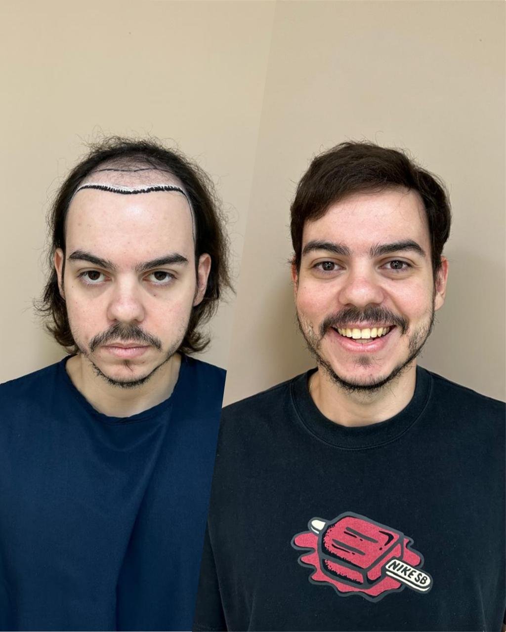 Antes e depois do transplante capilar de João Pedro, vista frontal