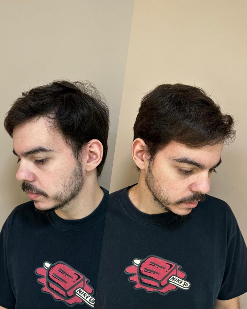 Antes e depois do transplante capilar de João Pedro, vista lateral