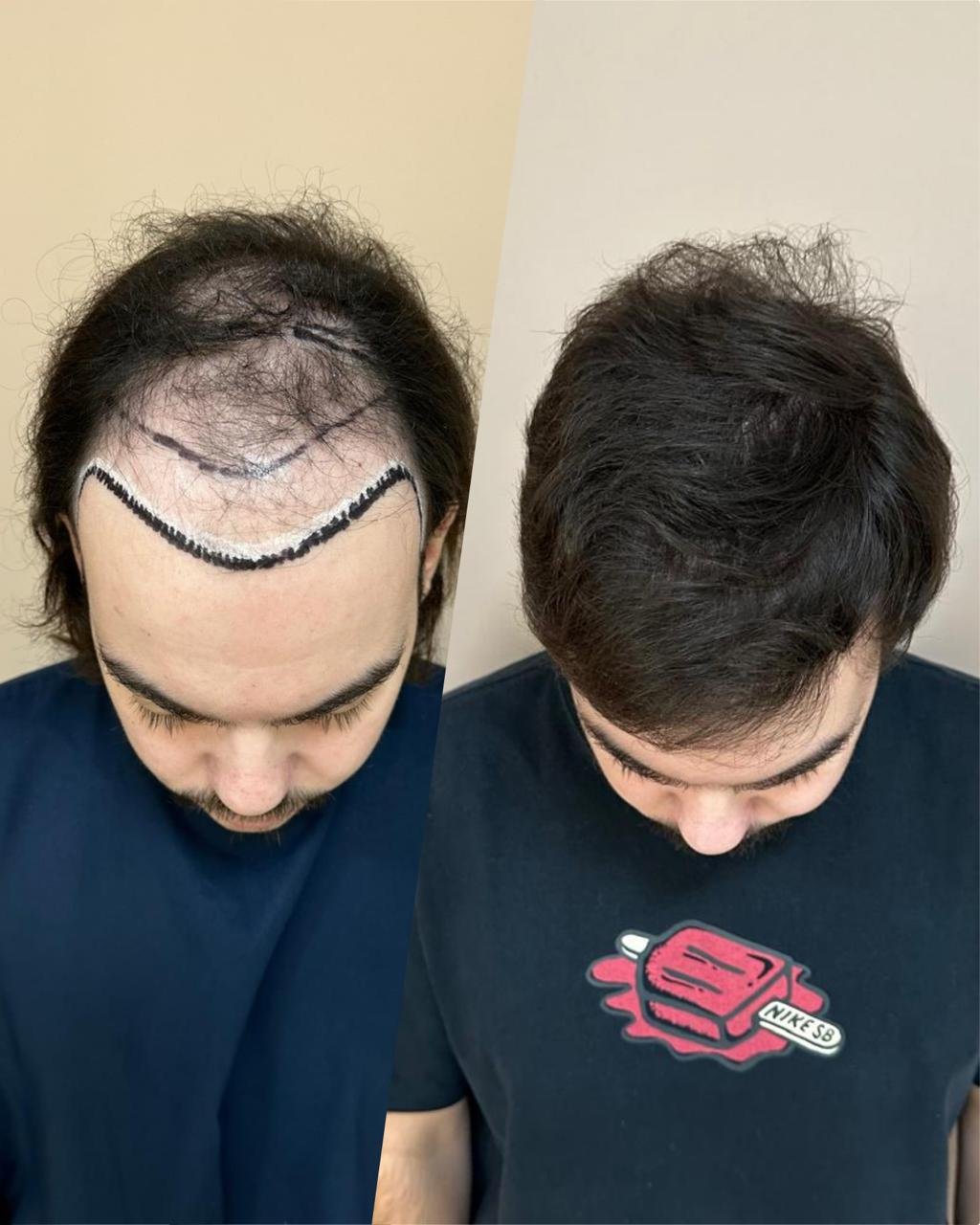 Antes e depois do transplante capilar de João Pedro, vista superior