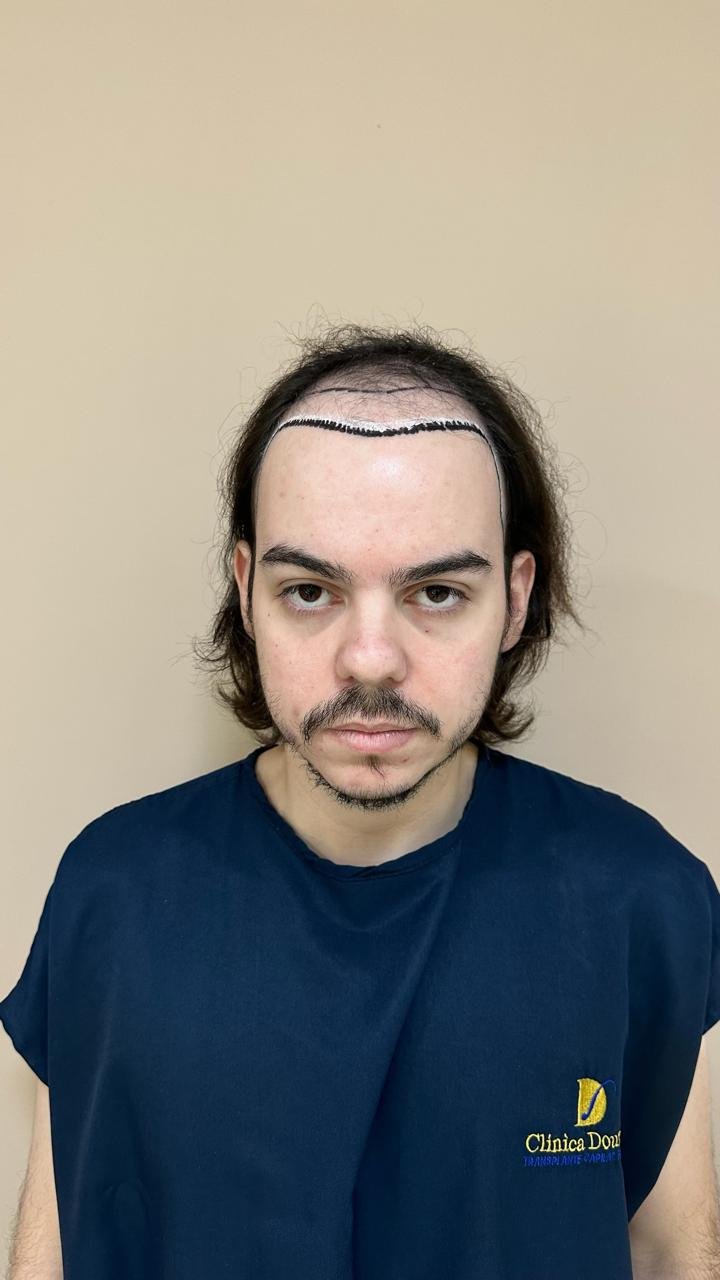 João Pedro antes do transplante capilar, calvície grau 5 vista frontal