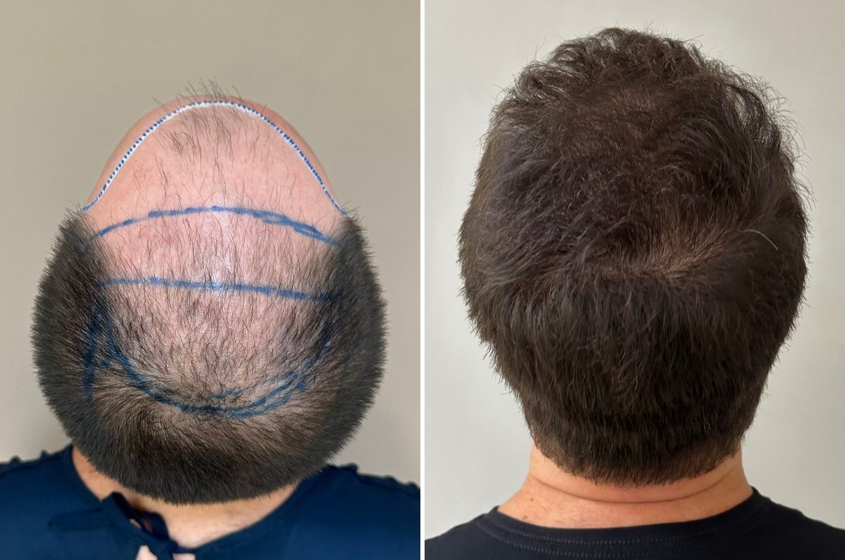 Antes e depois da coroa de Alisson, 8 meses após o transplante capilar