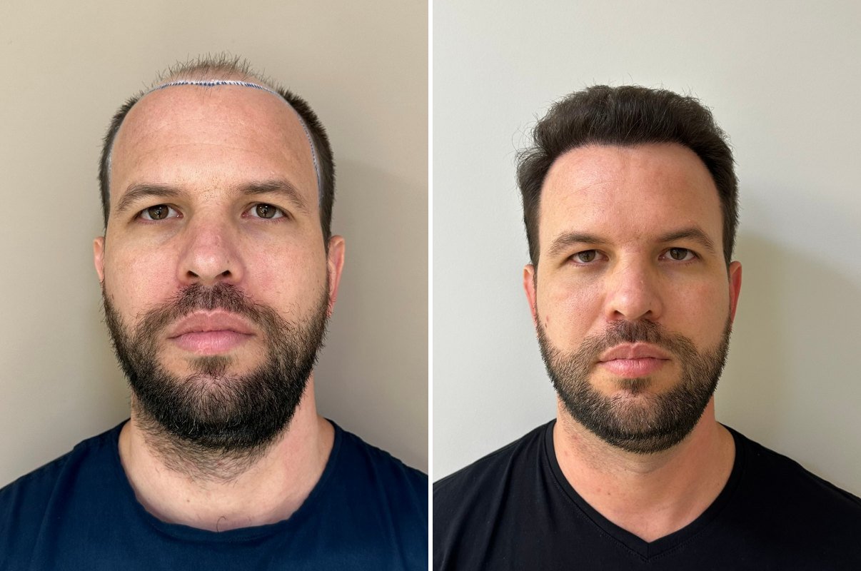 Antes e depois do transplante capilar de Alisson, vista frontal, 8 meses após