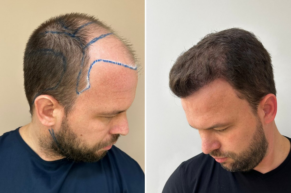 Antes e depois do transplante capilar de Alisson, lateral direita, 8 meses após