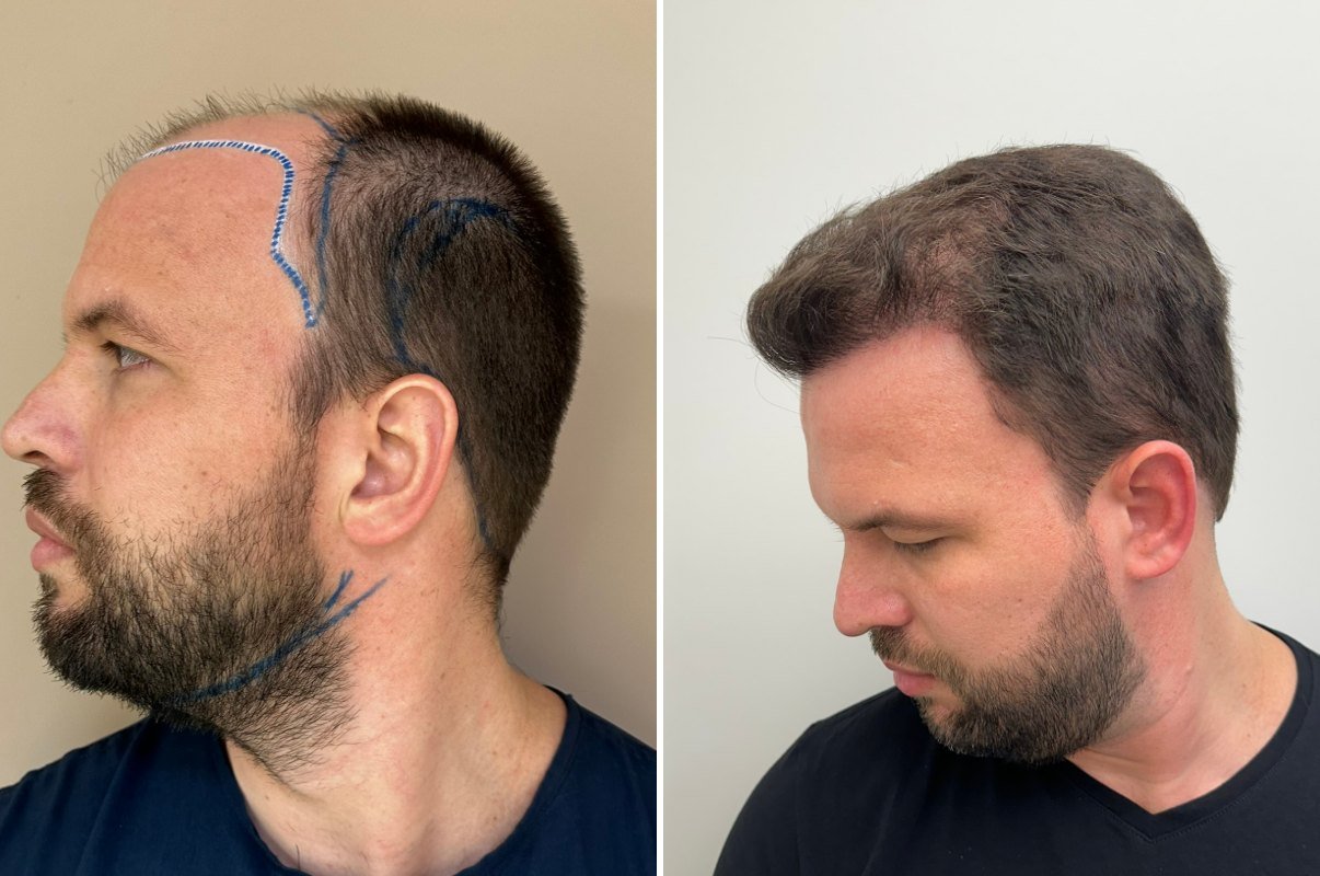 Antes e depois do transplante capilar de Alisson, vista lateral, 8 meses após