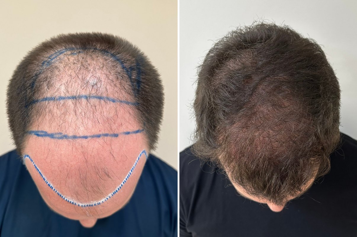 Antes e depois do transplante capilar de Alisson, vista superior, 8 meses após