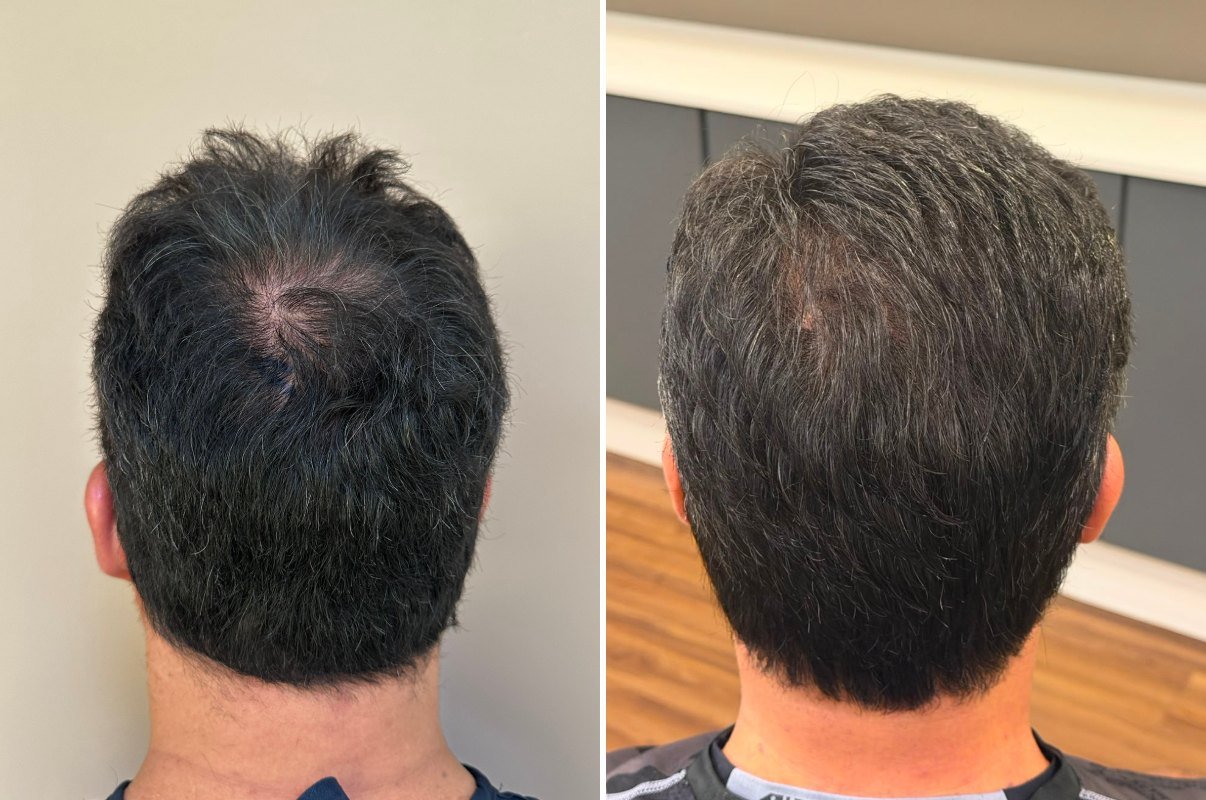 Antes e depois da coroa de Igor, 1 ano após o transplante capilar
