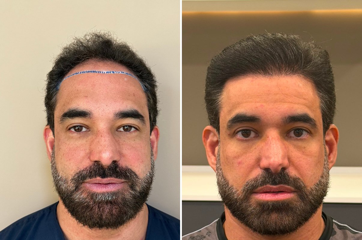 Antes e depois do transplante capilar de Igor, vista frontal, 1 ano após