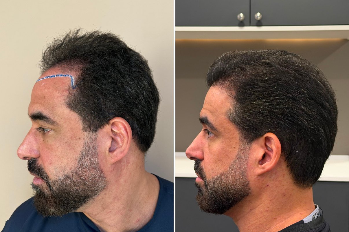 Antes e depois do transplante capilar de Igor, vista lateral, 1 ano após