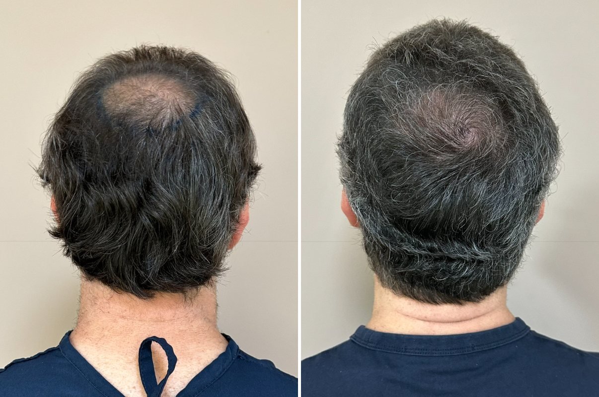Antes e depois da coroa de Marcelo, 6 meses após o transplante capilar