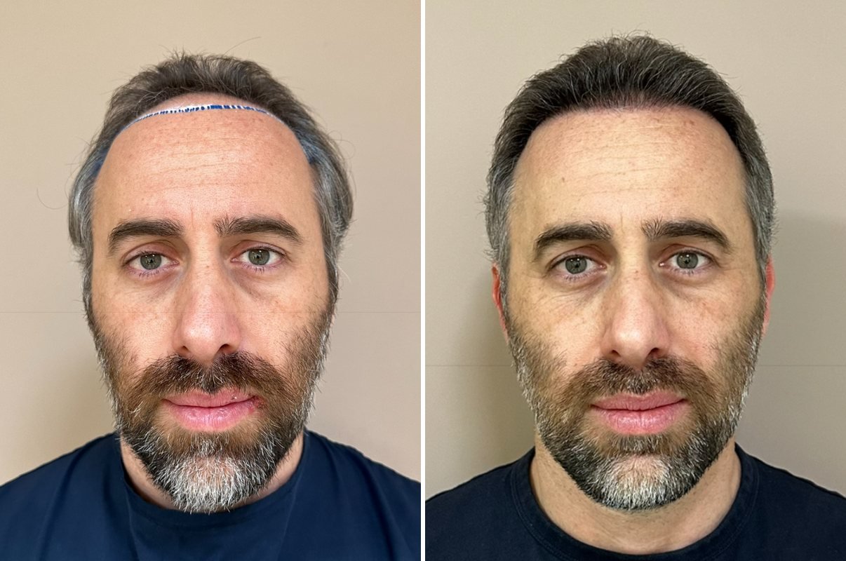 Antes e depois do transplante capilar de Marcelo, vista frontal, 6 meses após