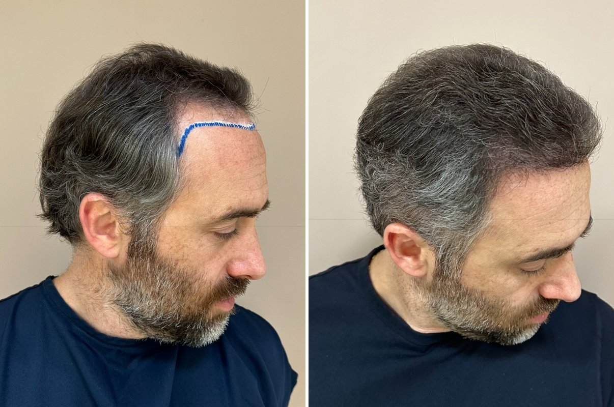 Antes e depois do transplante capilar de Marcelo, vista lateral, 6 meses após