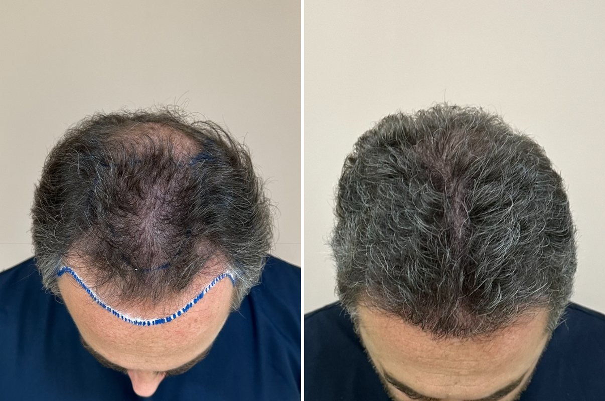 Antes e depois do transplante capilar de Marcelo, vista superior, 6 meses após