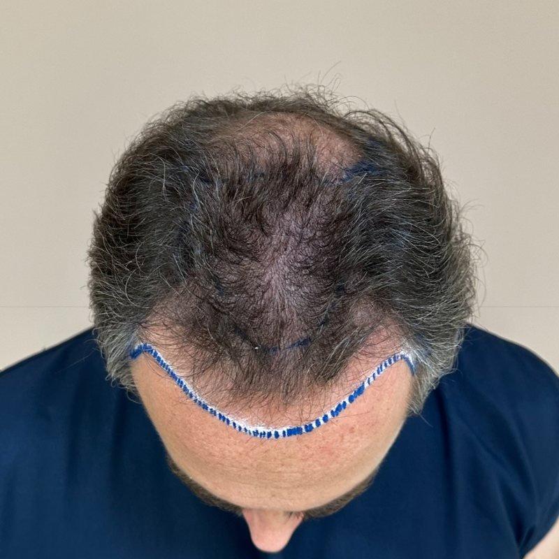 Vista superior da calvície grau 5 de Marcelo, com a nova linha frontal marcada antes do transplante capilar