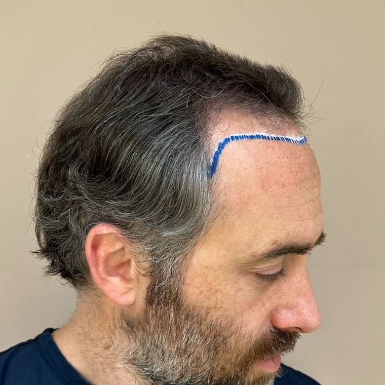 Desenho da nova linha frontal de Marcelo antes do transplante capilar