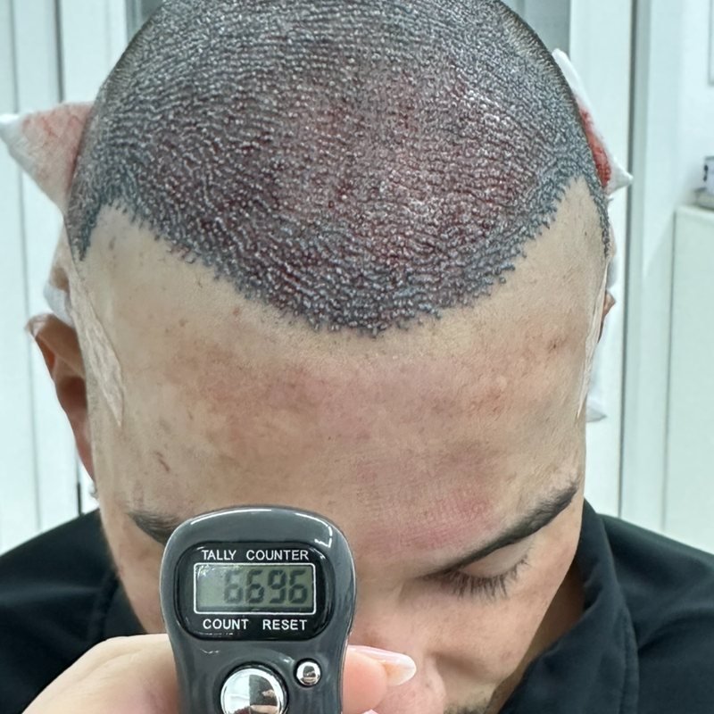 Contador marcando 6.696 folículos implantados no transplante capilar de Pedro Henrique