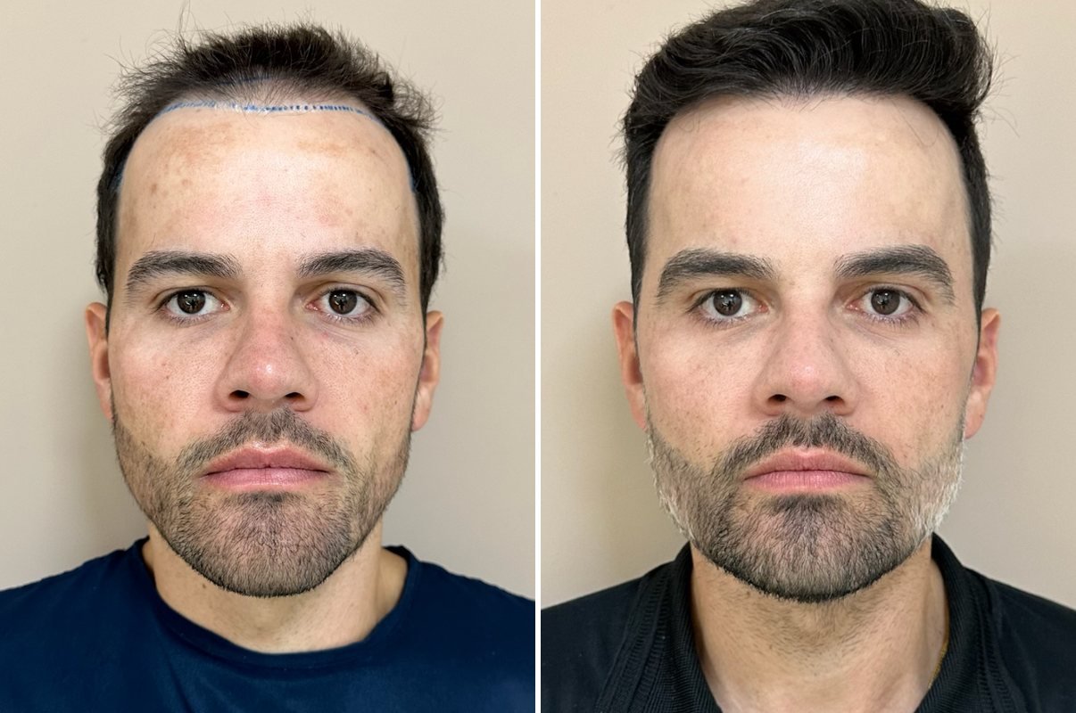 Antes e depois do transplante capilar de Pedro Henrique, vista frontal, mais de 1 ano após