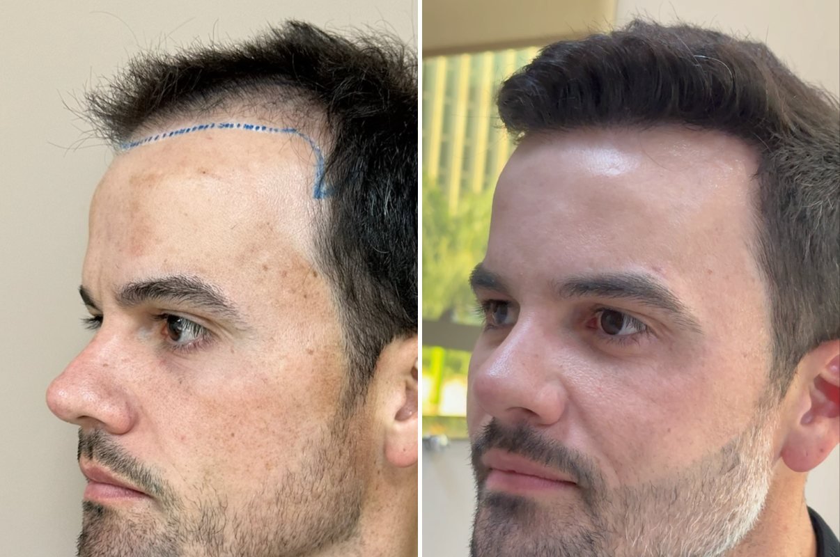 Antes e depois do transplante capilar de Pedro Henrique, vista lateral, mais de 1 ano após