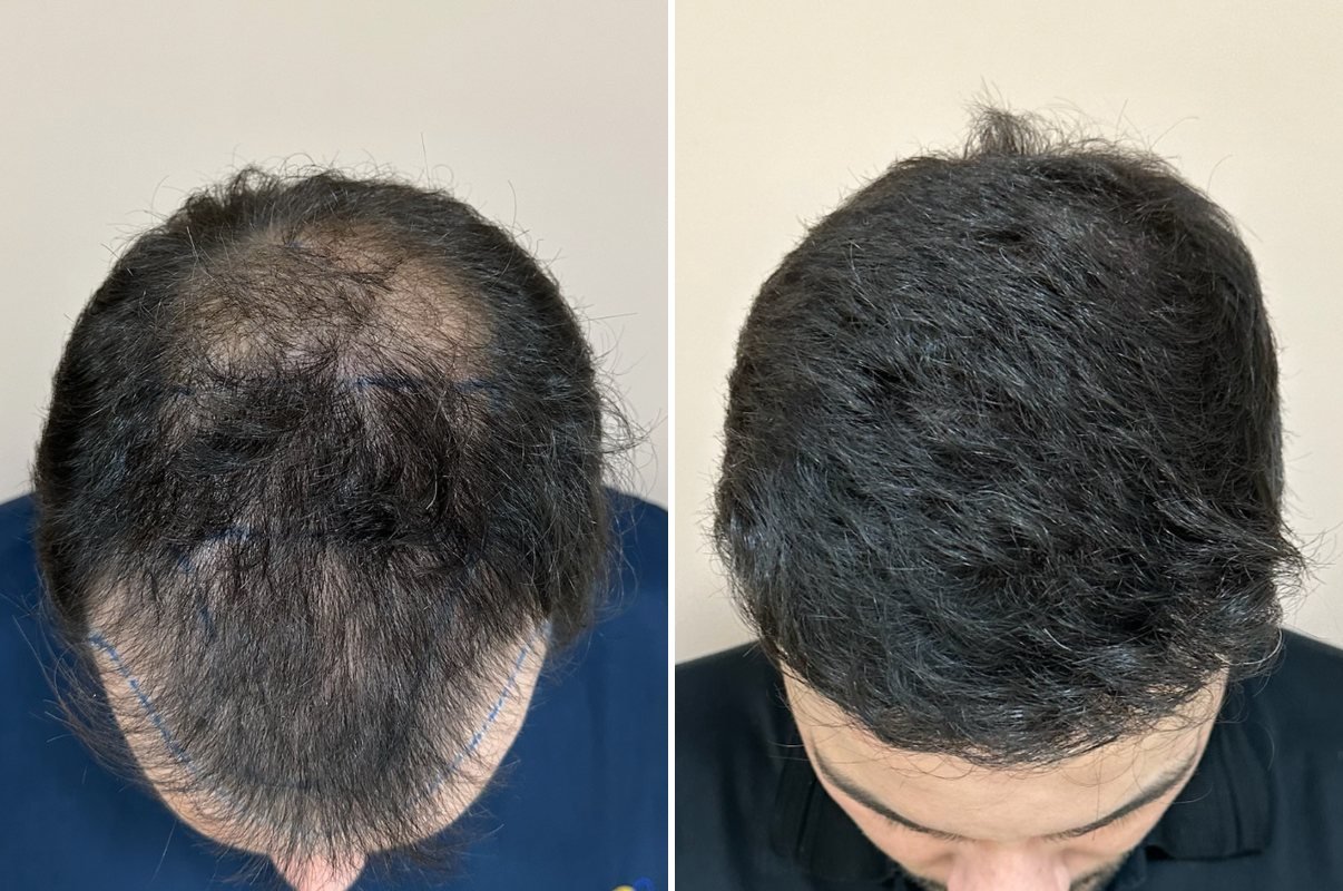 Antes e depois do transplante capilar de Pedro Henrique, vista superior, mais de 1 ano após