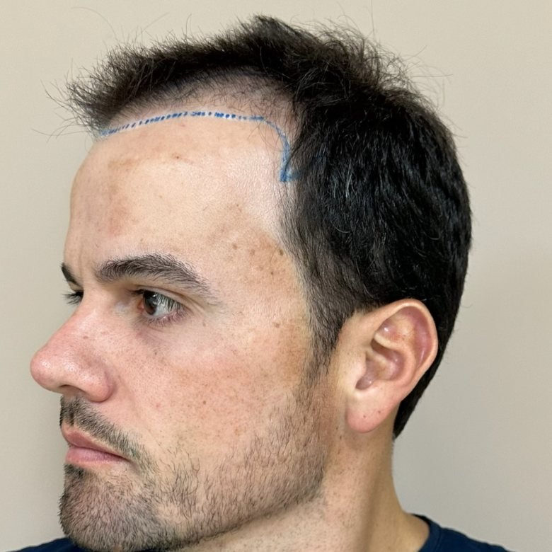 Desenho da nova linha frontal de Pedro Henrique antes do transplante capilar