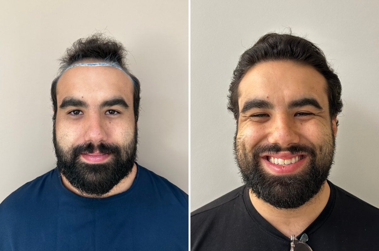 Antes e depois do transplante capilar de Pedro Lucca, vista frontal, 5 meses após
