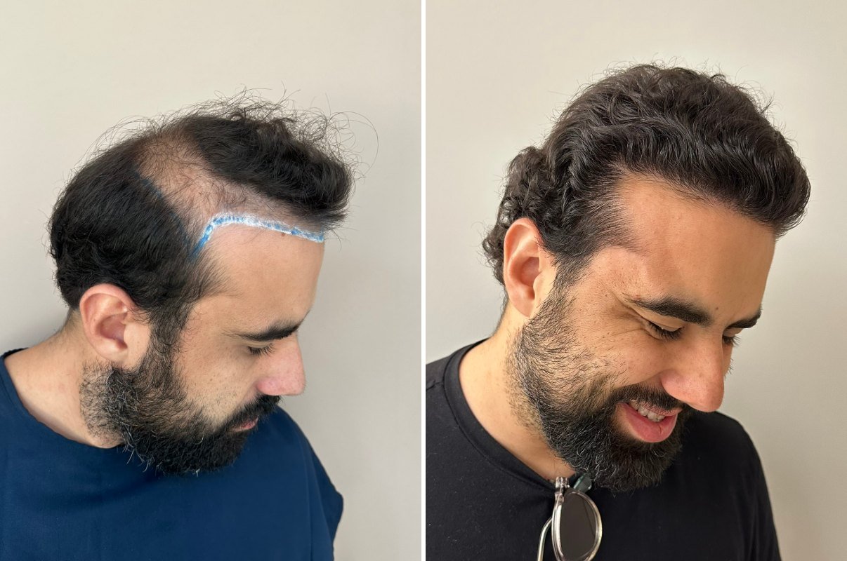 Antes e depois do transplante capilar de Pedro Lucca, vista lateral, 5 meses após