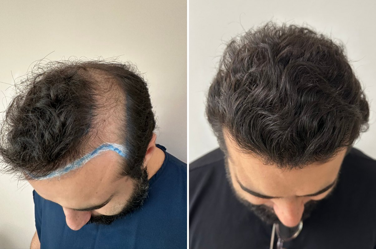 Antes e depois do transplante capilar de Pedro Lucca, linha frontal vista de cima, 5 meses após