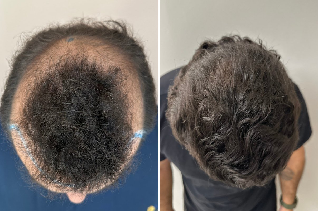 Antes e depois do transplante capilar de Pedro Lucca, topo e coroa, 5 meses após