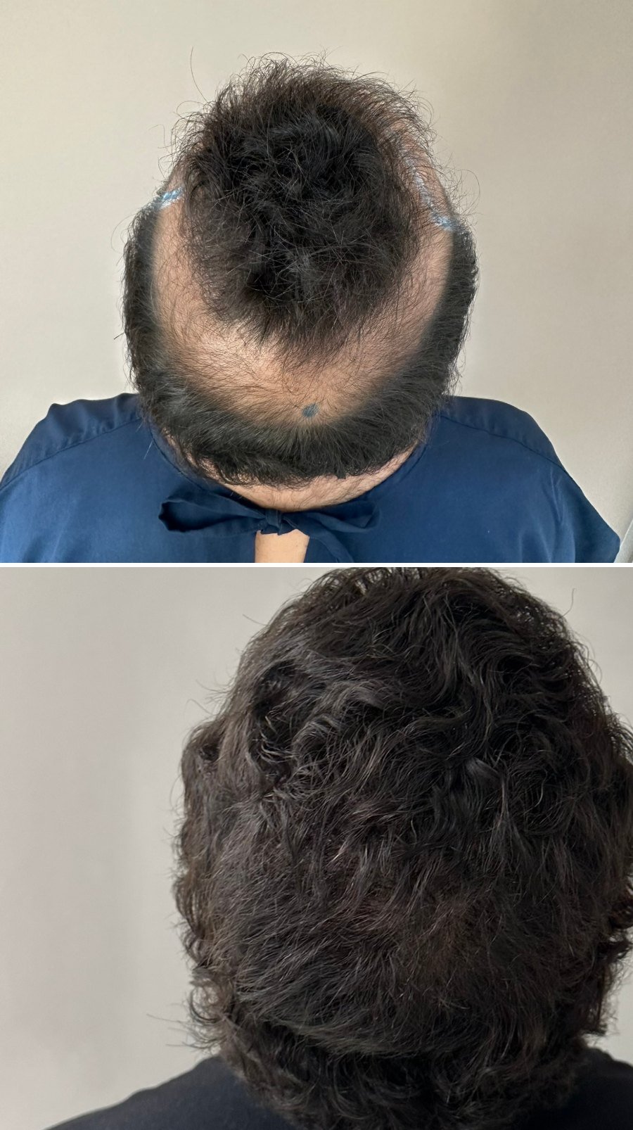 Região posterior da cabeça de Pedro Lucca antes e 5 meses após o transplante capilar com FUE e BHT