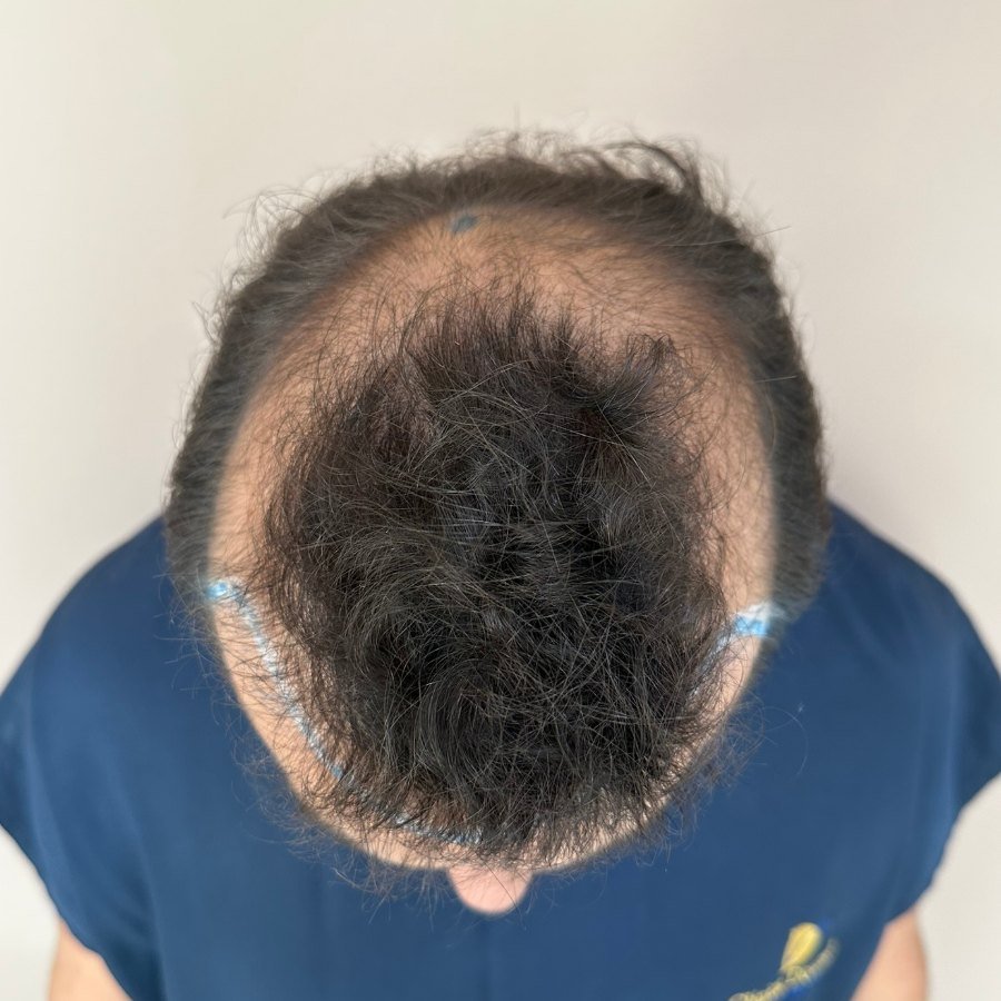 Calvície grau 5 de Pedro Lucca na avaliação, com rarefação na coroa